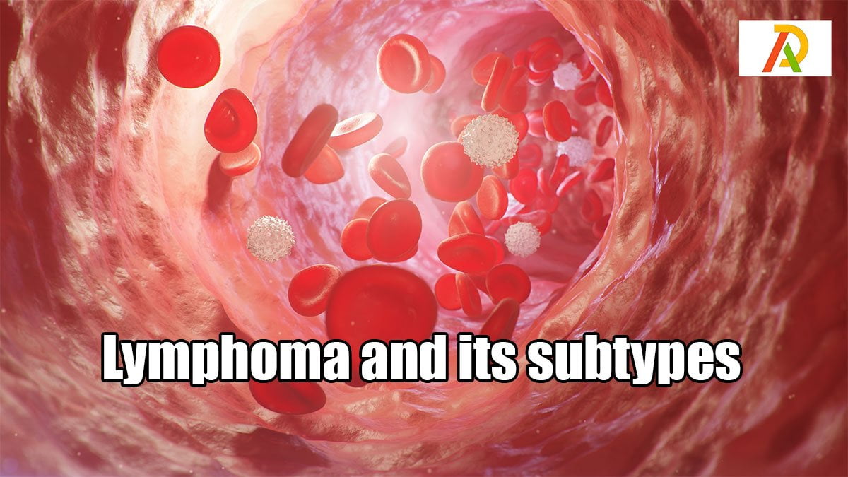 Lymphoma-and-its-subtypes