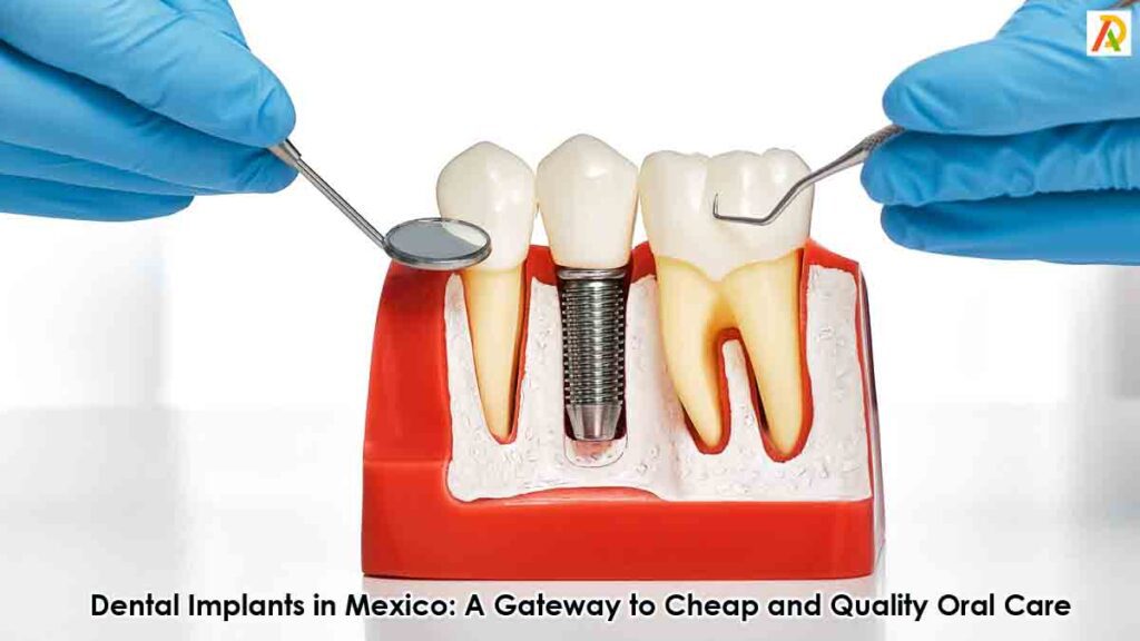 dental-implants