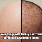 Empower-Your-Image-with-Turkey-Hair-Transplants-at-Veraclinic-A-Complete-Guide